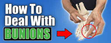 How to deal with bunions